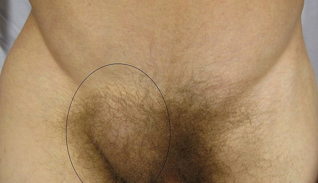 Photo d’une hernie inguinale chez l’homme