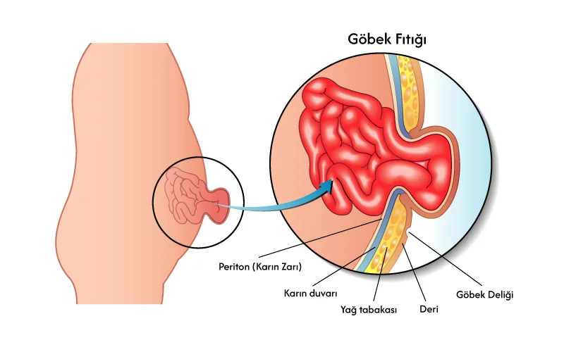 Göbek Fıtığı Nedir? Belirtileri, Nedenleri ve Ameliyatı