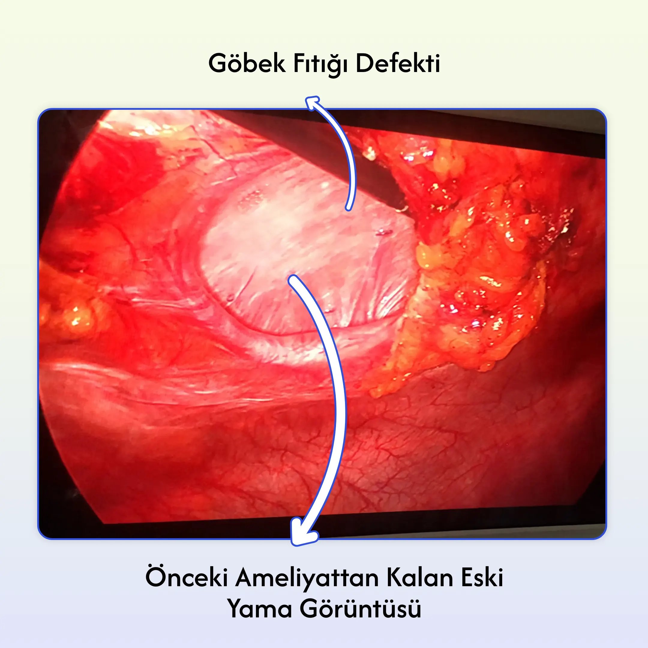 Umbilical Hernia Surgery in Turkey Umbilical-hernia defect