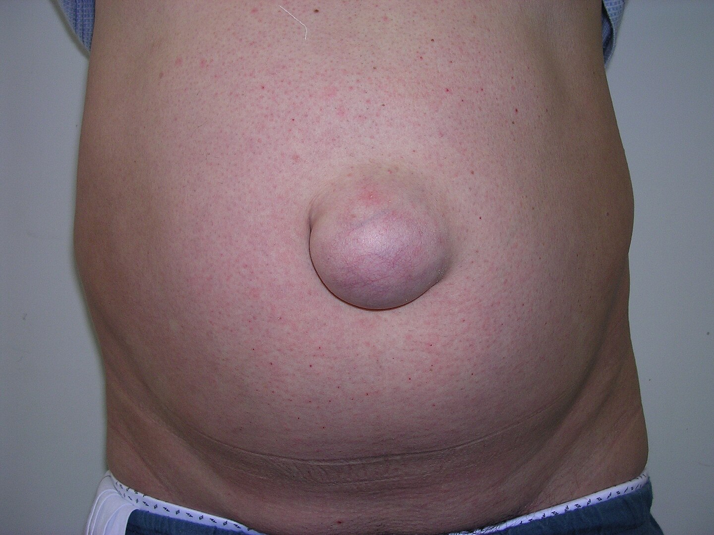 Umbilical Hernia Surgery in Turkey Umbilical hernia in an adult
